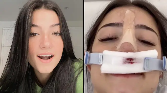 Charli broke her nose back in August 2019 and has struggled with breathing issues ever since.