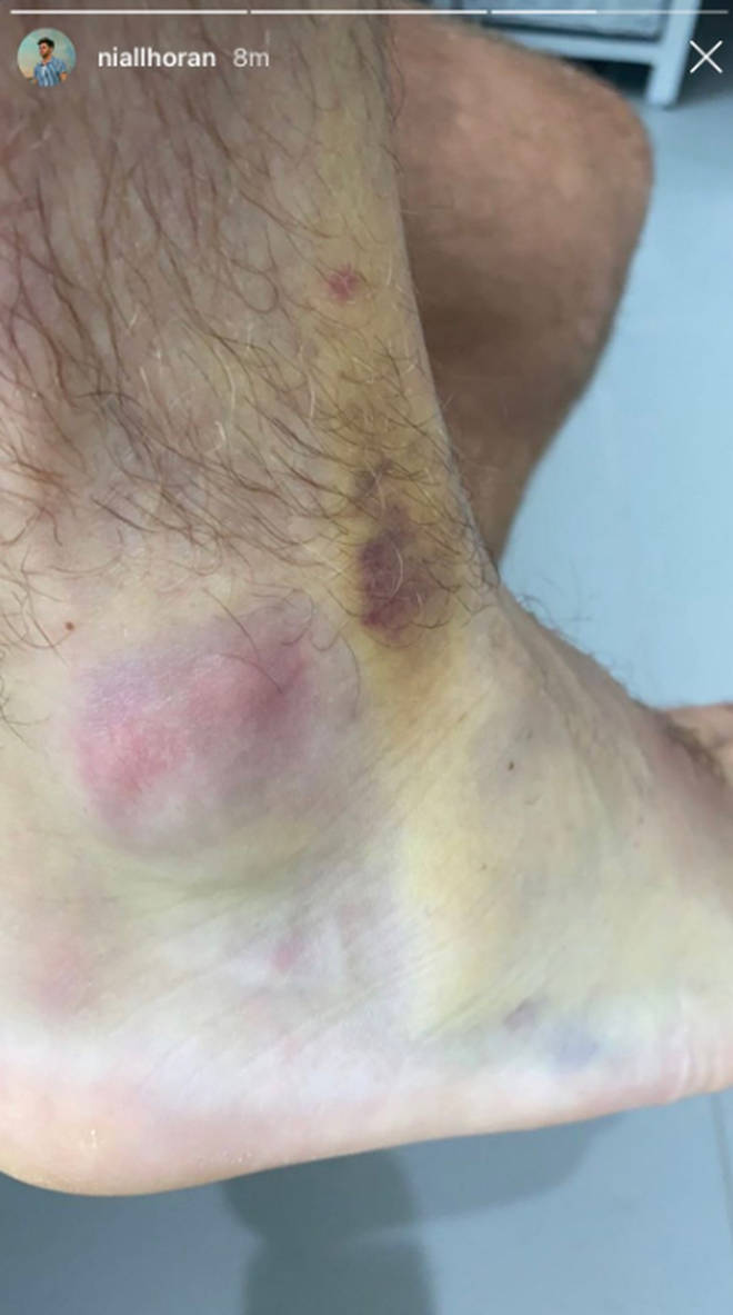 Niall Horan shared a photo of his bruised foot on Instagram