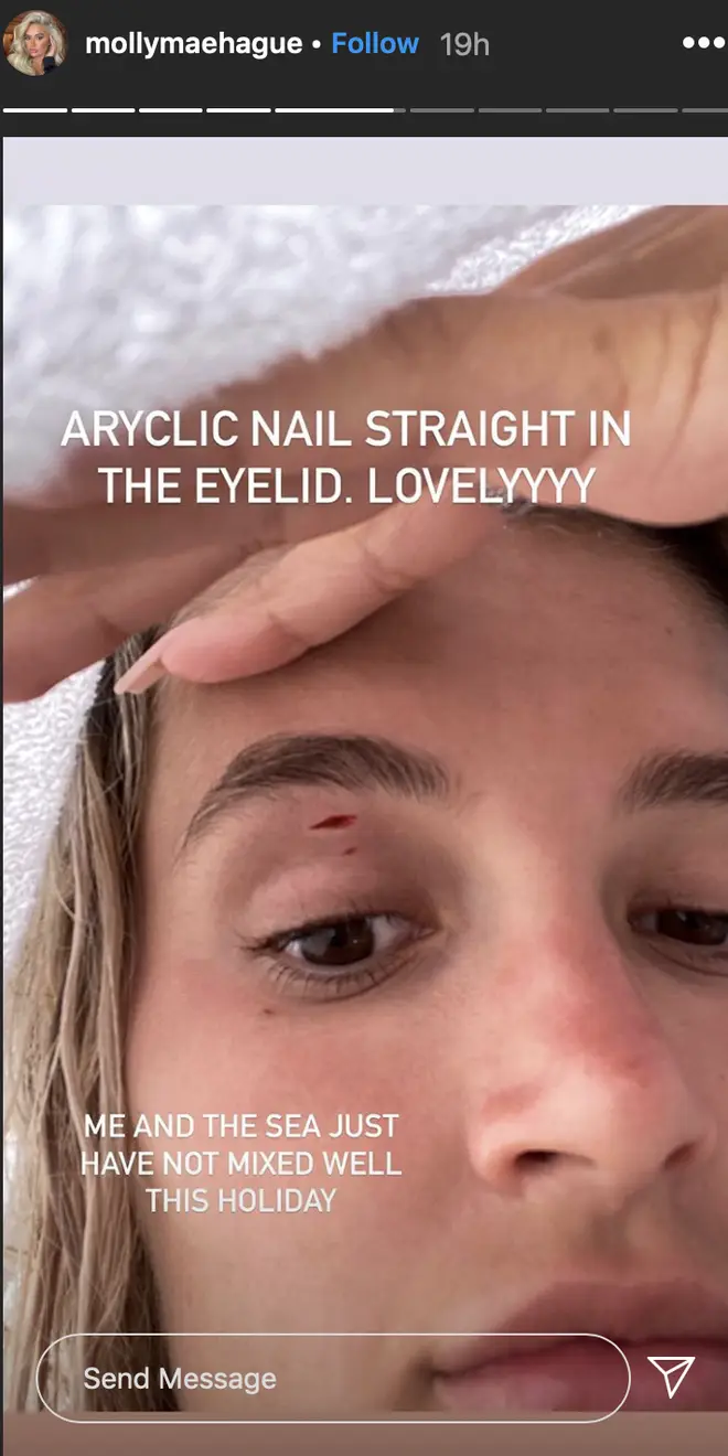 Molly-Mae showed fans a close-up snap of the cut above her eye