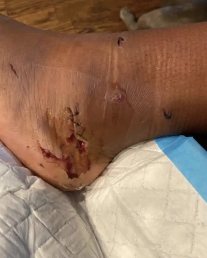 Megan Thee Stallion shared a picture of her healing injuries