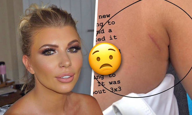Olivia Buckland revealed she had a lump removed that turned out to be a lipoma