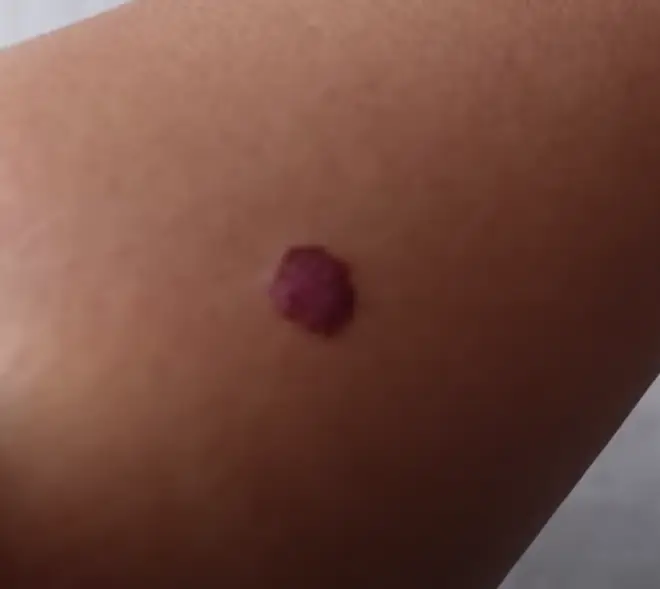 Molly-Mae Hague shows the cancerous mole being removed