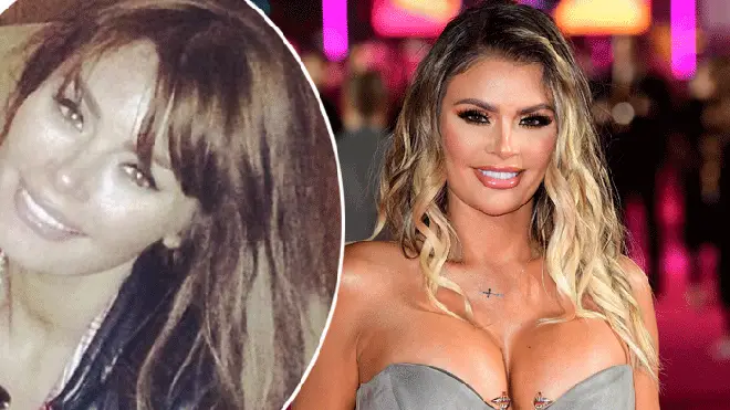 Chloe Sims before and after surgery pictures