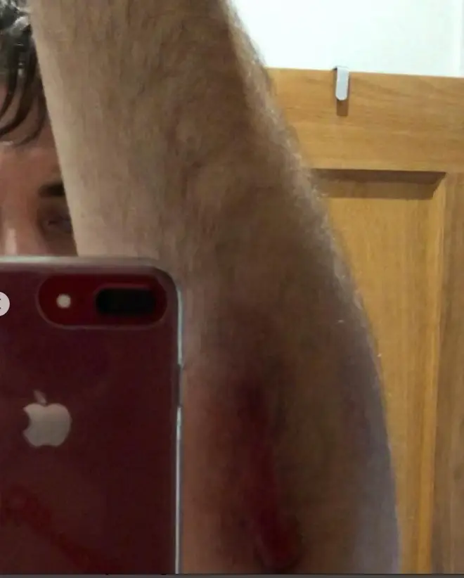 James Argent shared pictures of his motorbike crash injuries on Instagram