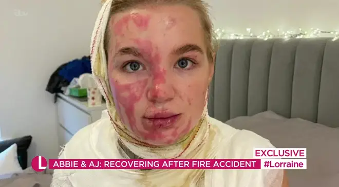 Abbie Quinnen suffered major burns following the fire accident.