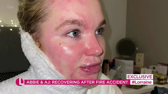Abbie Quinnen underwent three skin grafts following the fire accident.
