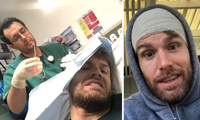 Joel Dommett had to get stitches for his head injury.