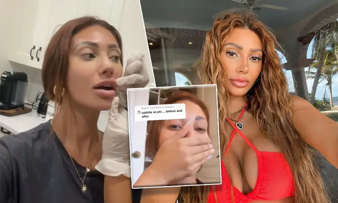 Francesca Farago has documented the removal of her fillers