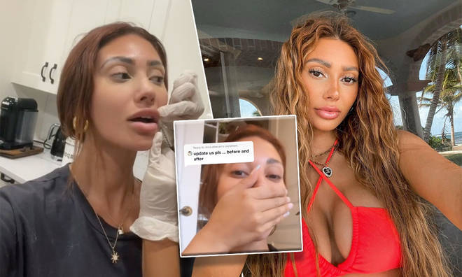 Francesca Farago has documented the removal of her fillers