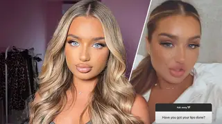 Lucinda Strafford opened up about having had lip fillers in the past