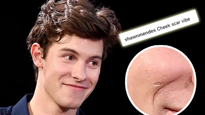Shawn Mendes' cheek scar.