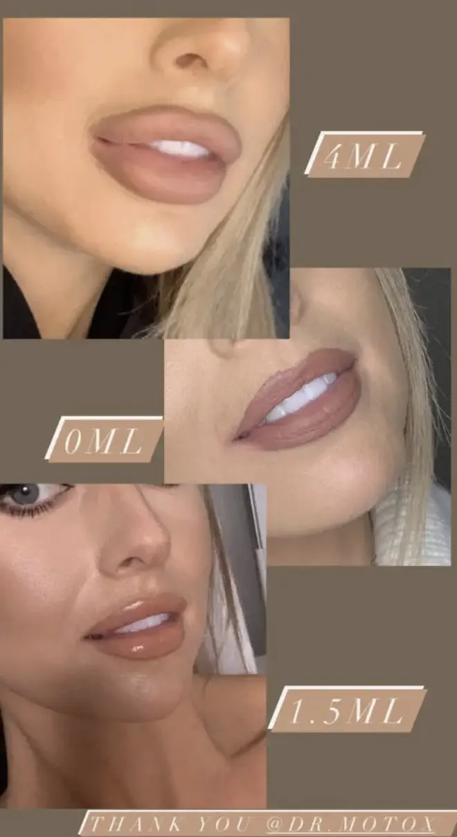 Faye Winter had her fillers dissolved and put a smaller amount back in