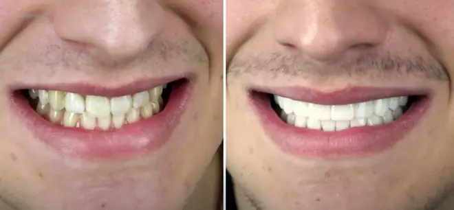 Luca Bish's teeth before and after veneers