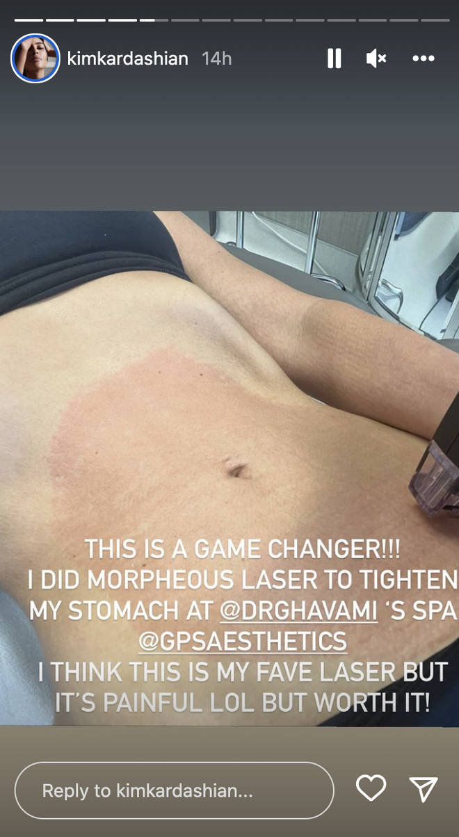 Kim Kardashian showed off the results of her laser stomach tightening procedure