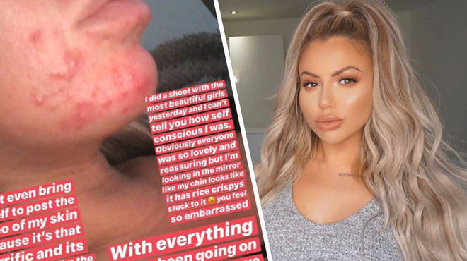 Holly Hagan opened up about her struggles with acne.