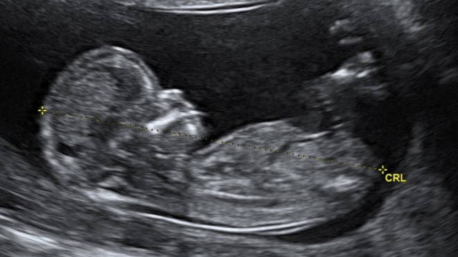 Justin Bieber and Hailey Baldwin's baby as shown on their ultrasound scan