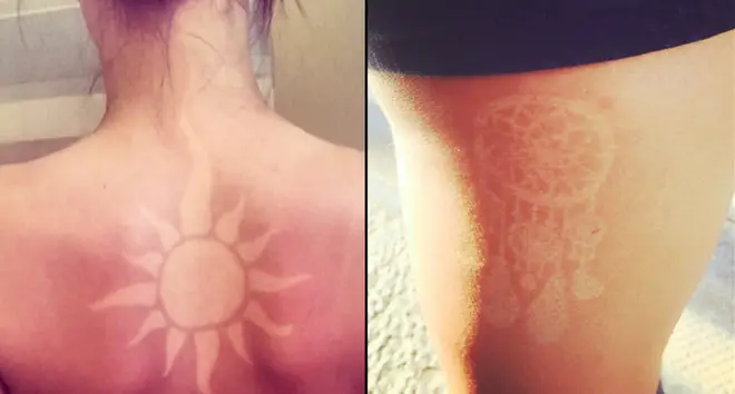Sunburn Tattoo Art