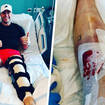 Olly Murs shared photos of him knee surgery
