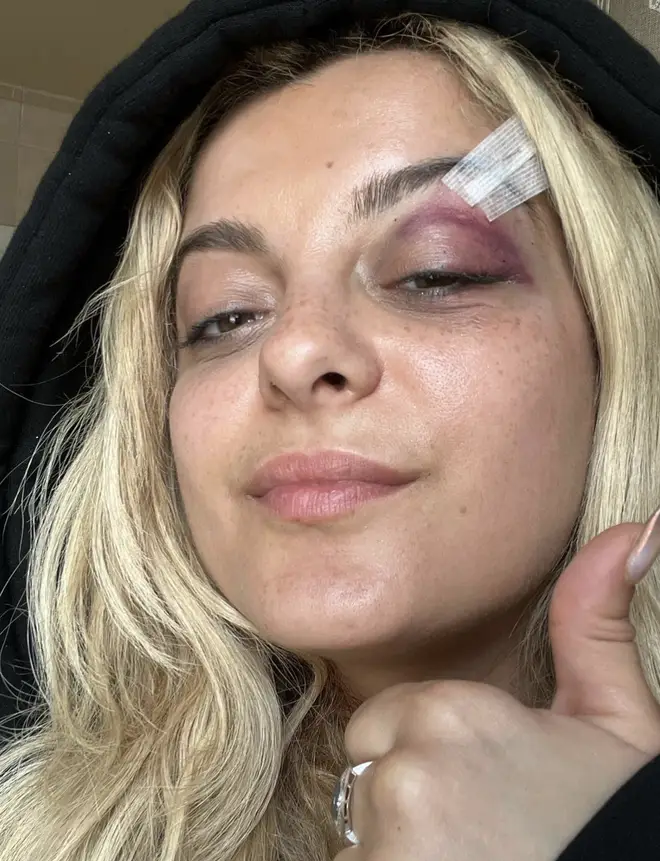 Bebe Rexha was left with a black eye after a fan threw a phone at her