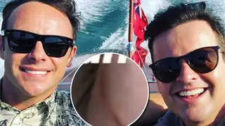 Dec was seen with a burn on the opening episode of I'm A Celebrity...